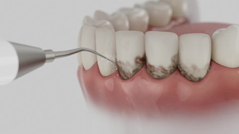 Trusted Wisdom Tooth Removal service in Constantine, MI - Dentist Open Now